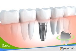 Slider image (4) Evolution Implant Center